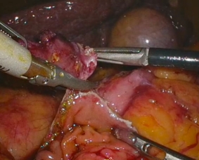腹腔胸・内視鏡合同手術